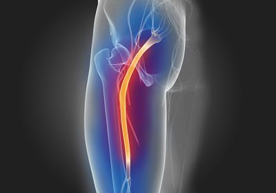 Sciatica Pain Relief