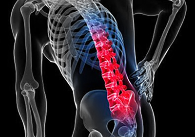 Slip Disk L4-L5-S1 Treatment